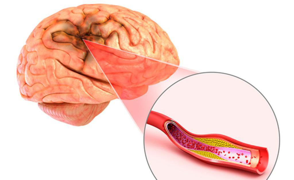 Причины ишемической. Атеросклероз сосудов головного мозга. Церебральный атеросклероз.