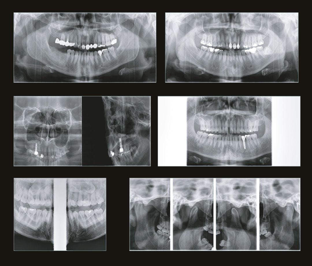 Виды рентгенологических исследований в стоматологической практике | Дентекс  - стоматологическое оборудование | Дзен