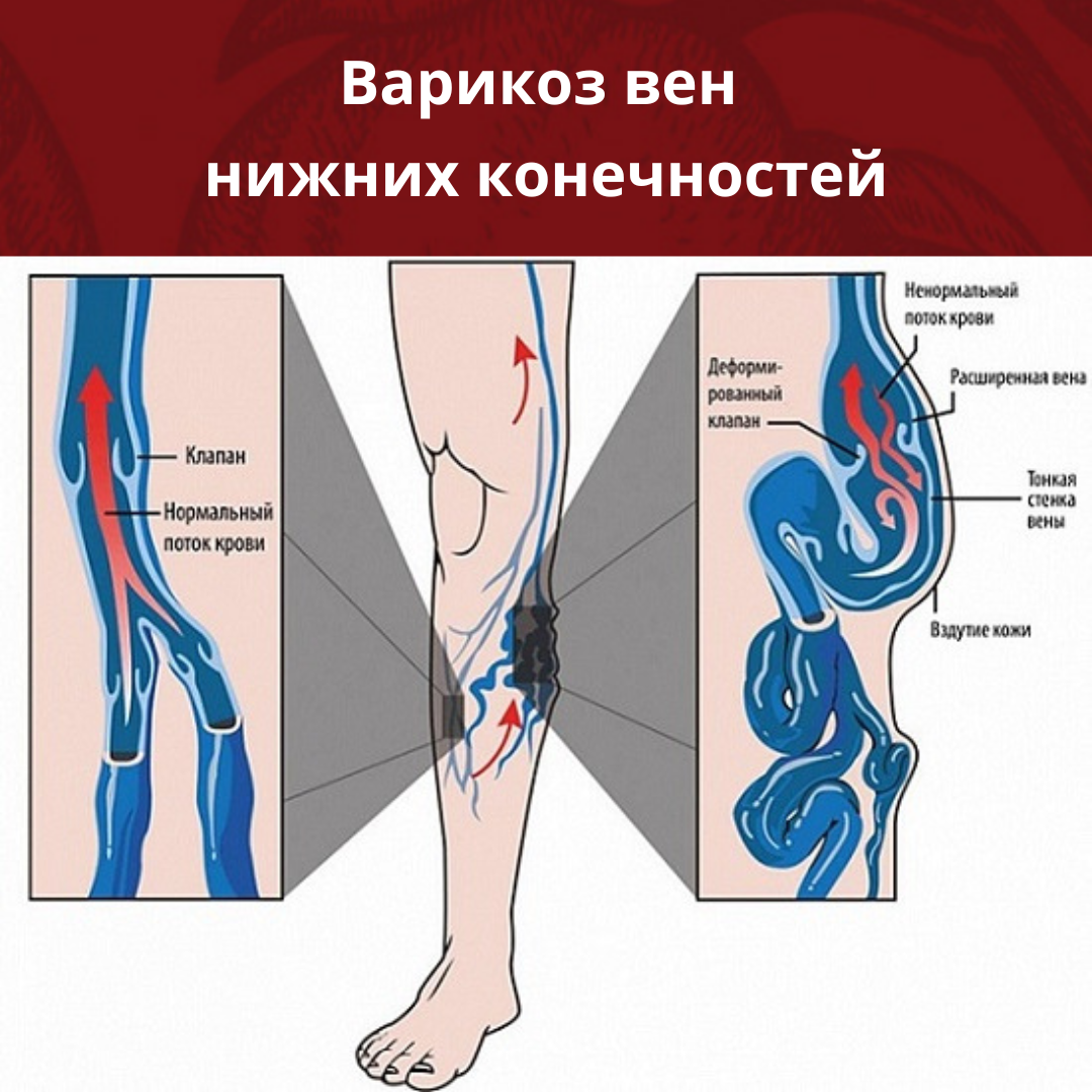 Недостаточность клапанов нижних конечностей