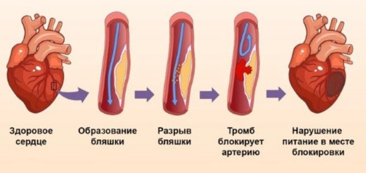 Симптомы ИБС инфаркт миокарда. Процесс развития инфаркта миокарда. Инфаркт миокарда это кратко. Инфаркт миокарда 3 типа.