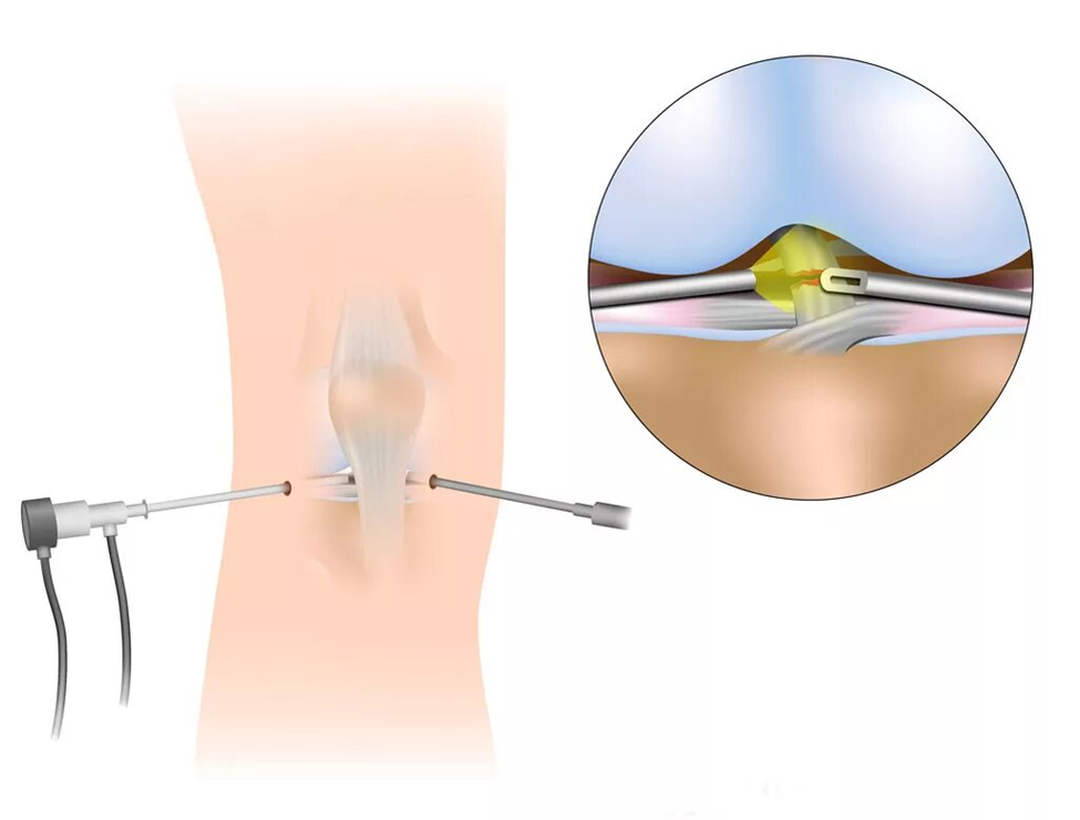 Артроскопическая резекция мениска. Разрыв мениска артроскопия. Артроскопия мениска осложнения. Операция артроскопия коленного сустава.