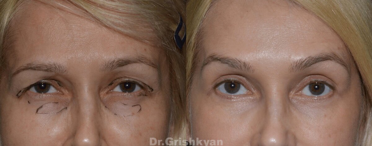 Блефаропластика верхних век фото до и после. Фото с сайта хирурга Д.Р. Гришкяна. Имеются противопоказания, требуется консультация специалиста