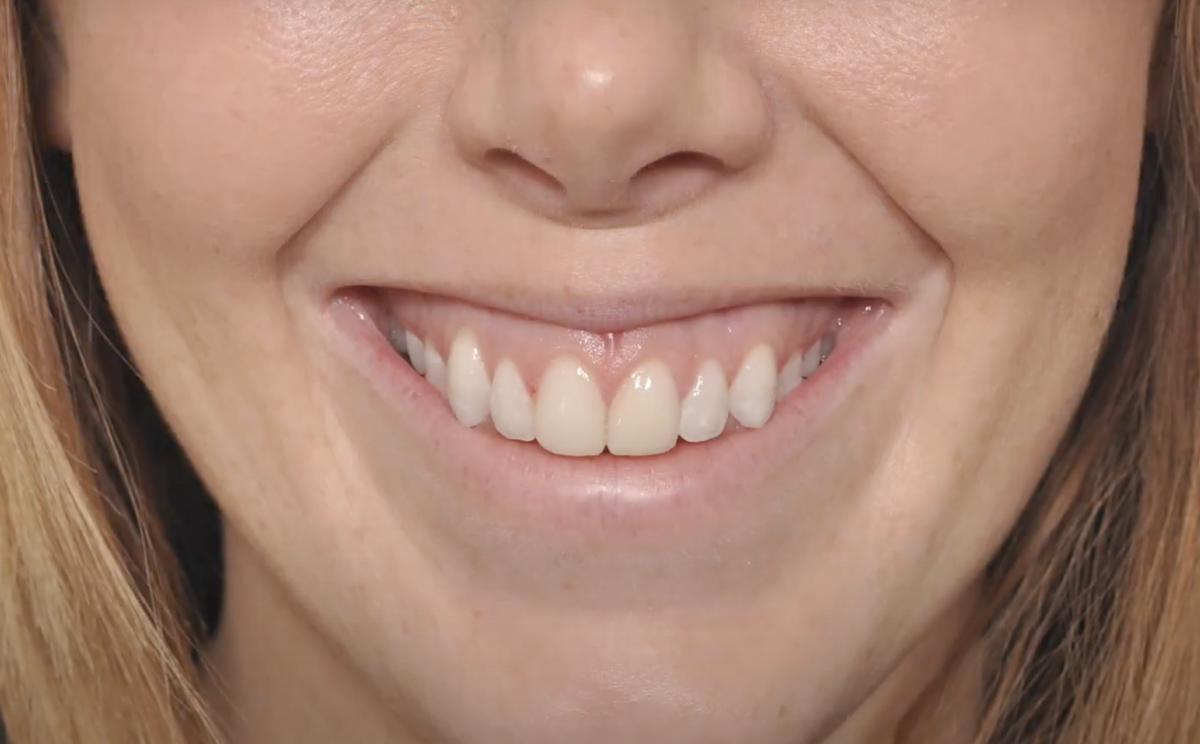 Почему большие зубы. Аня акулич десневая улыбка. десневая улыбка gummy smile. крупные зубы.
