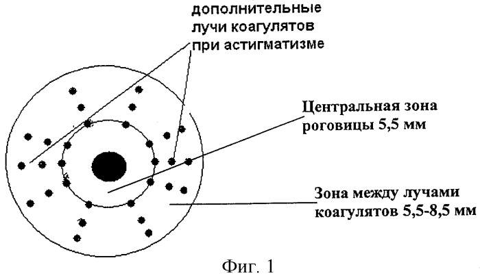 Подавляющее большинство людей старших возрастов сталкиваются с дальнозоркостью, но давайте попытаемся разобраться, какие способы, кроме ношения, очков способны улучшить качество жизни пожилых граждан.-2