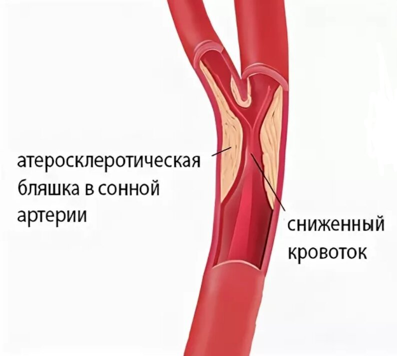 Атеросклероз артерий шеи