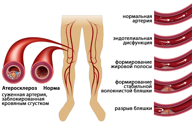 Atherosclerosis латынь. Облитерирующий атеросклероз нижних конечностей мкб. Атеросклероз сосудов нижних конечностей мкб. Атеросклероз артерий нижних конечностей мкб. Бляшки в сосудах нижних конечностей.