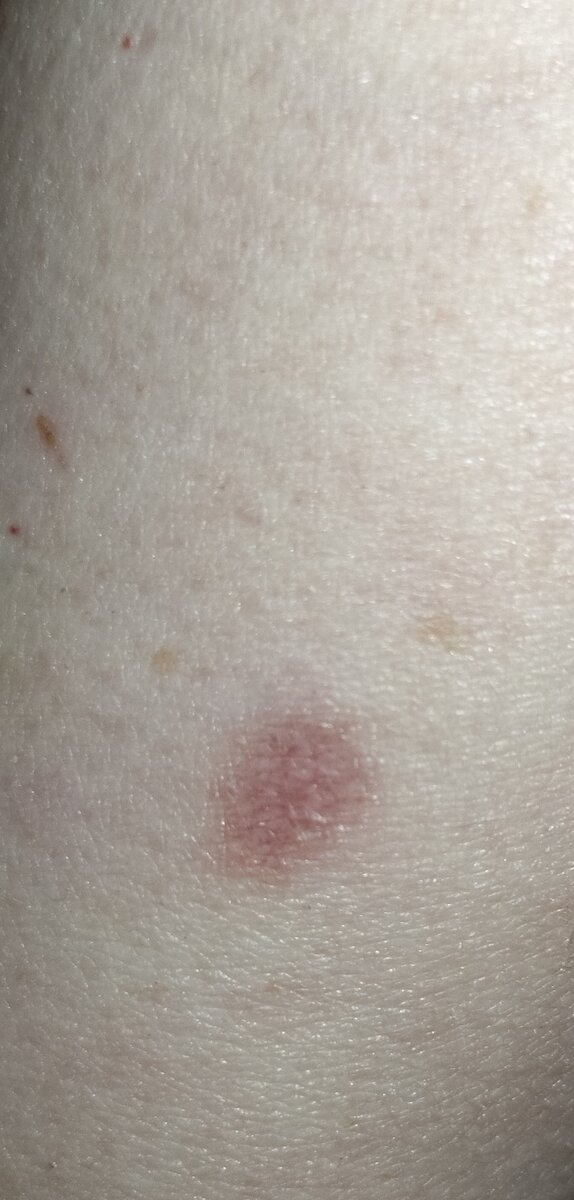 След от чьего-то коварного укуса