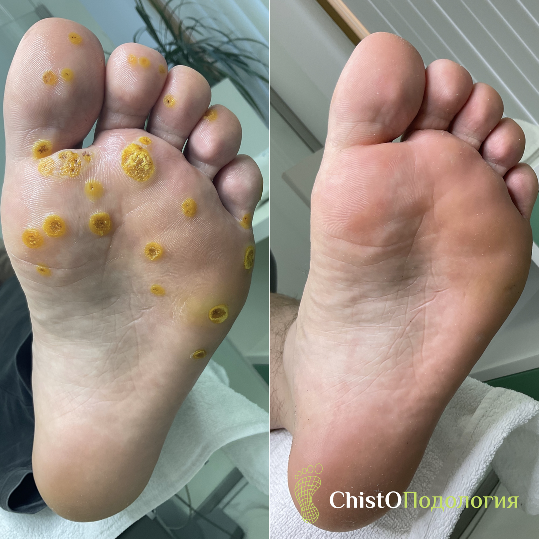 Бородавки: до и после