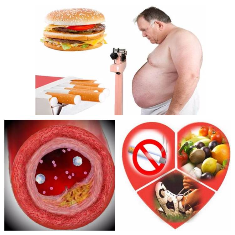 Лишний холестерин. Атеросклероз сосудов факторы риска. Факторы риска атеросклероза. Профилактика атеросклероза. Профилактика ожирения атеросклероза.
