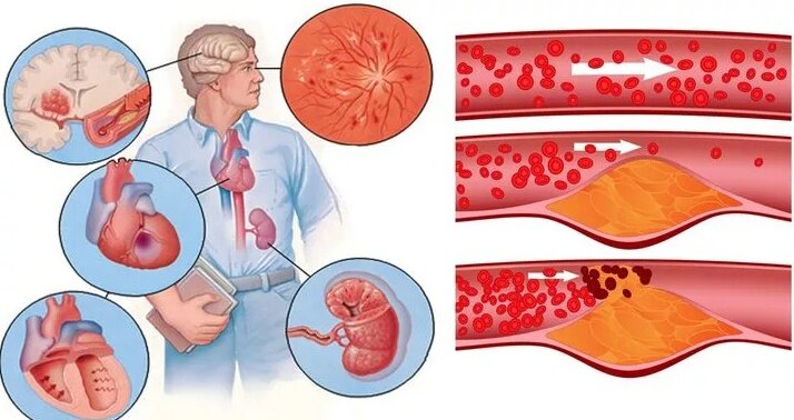 Признаки повышенного холестерина