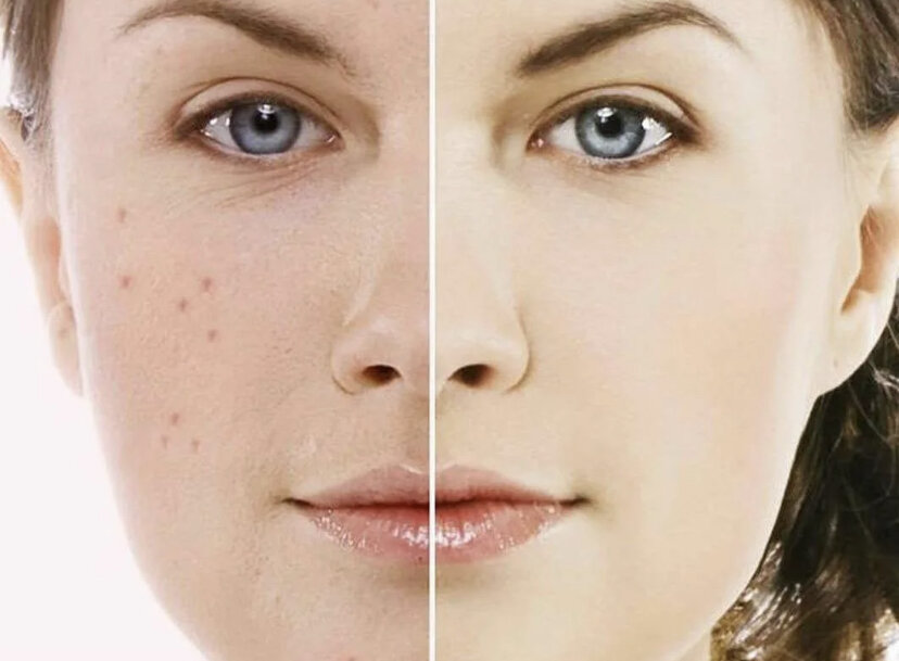 Как очистить кожу лица от прыщей | Красота и Здоровье | Дзен
