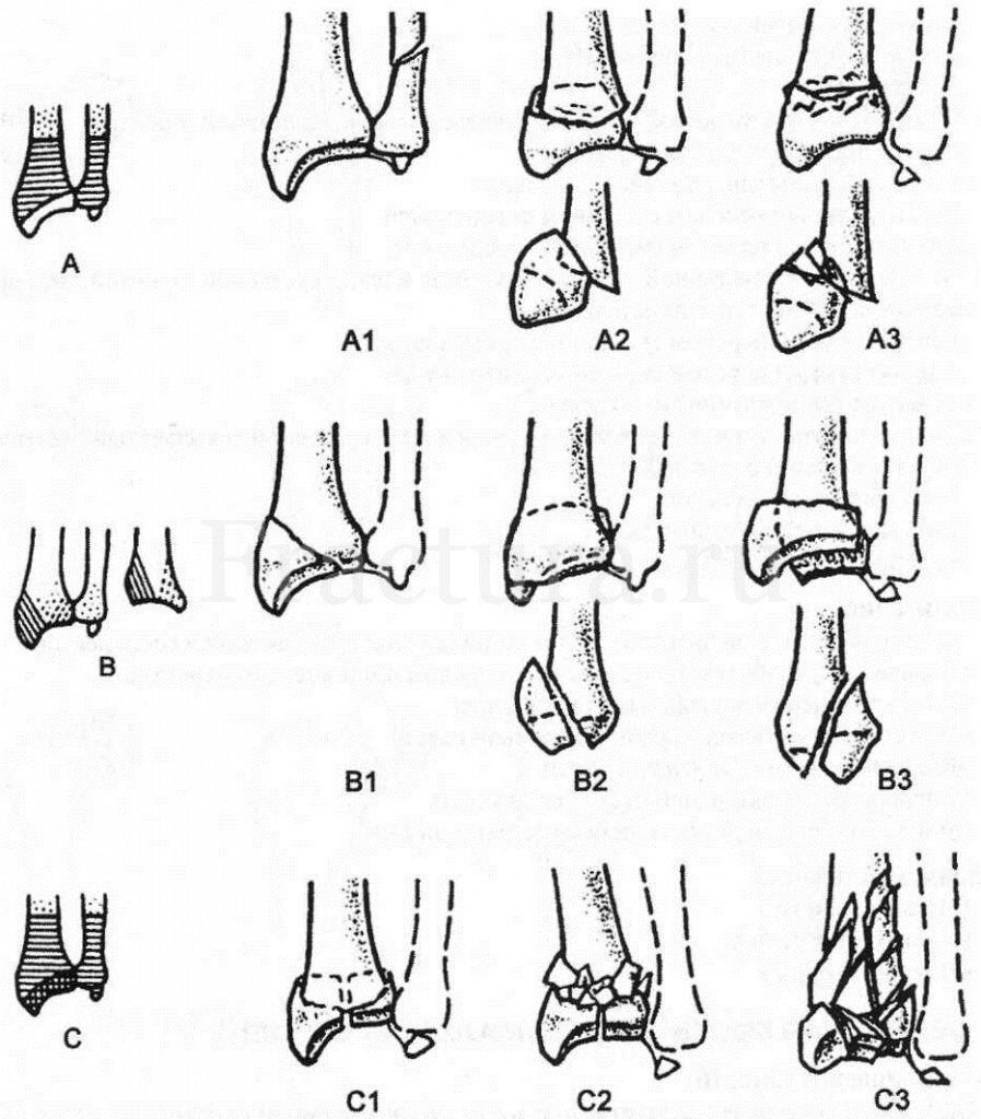 Классификация открытых переломов. Импрессионный перелом мыщелка большеберцовой кости. Классификация переломов костей конечностей. Классификация перелома дитслального эпифиза большеберцовой кости. Переломы проксимального отдела большеберцовой кости классификация.