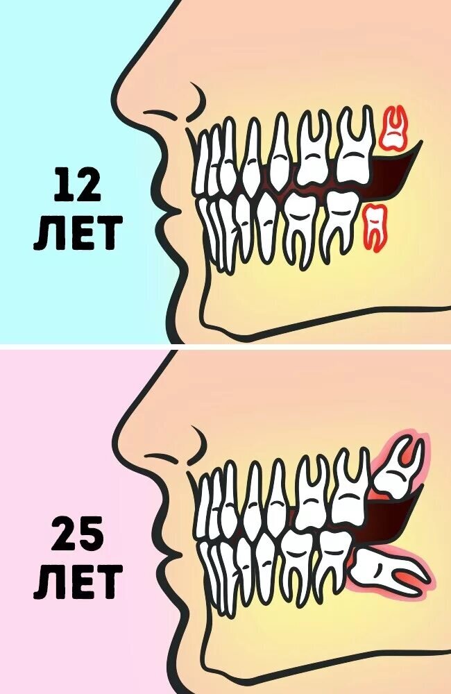 Где можно зубы. Удалённый зуб мудростт.