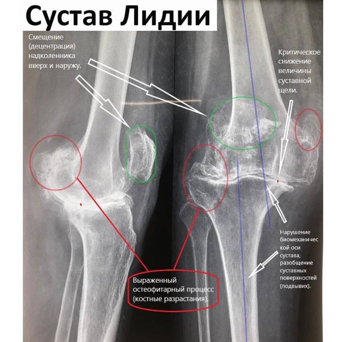 Наглядно про укольчики в суставы Пациенты, ранее получавшие многократно глюкокортикоиды в блокадах/капельницах - самые сложные.