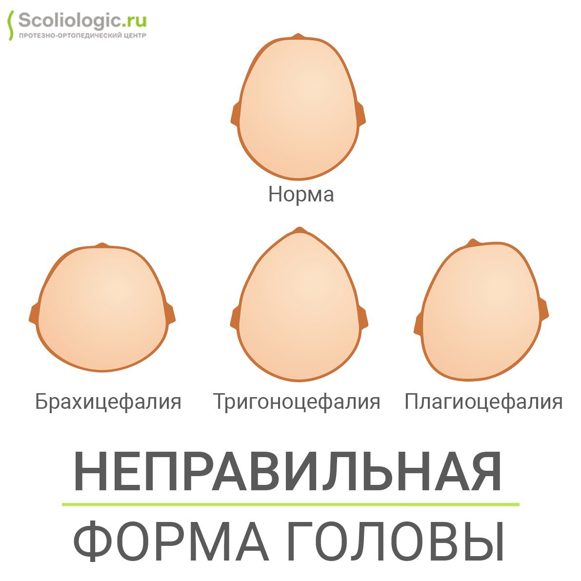 Треугольная форма головы у ребенка. Яйцевидная форма головы у ребёнка.