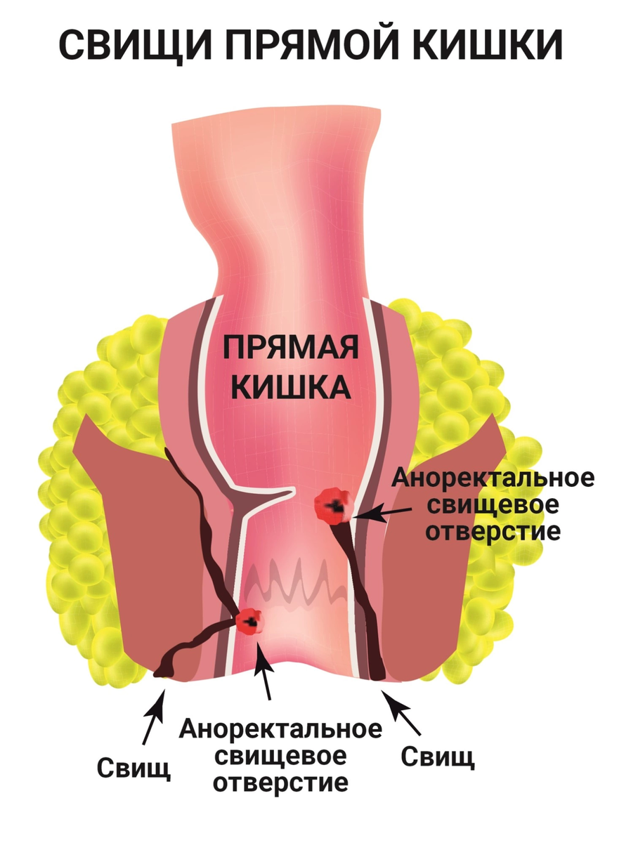 Анальный свищ | DUET CLINIC | Дзен