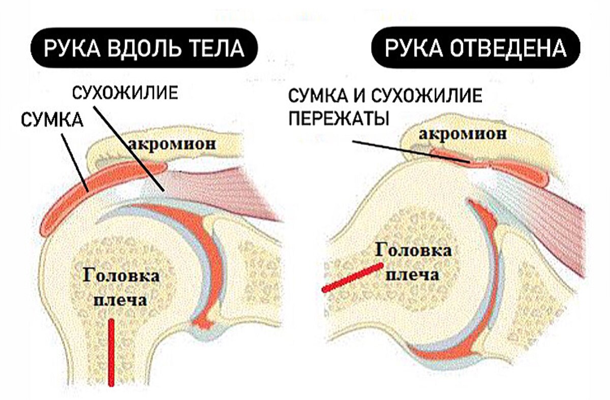 Синовиальная сумка и сухожилие прижимаются головкой плеча к акромиону