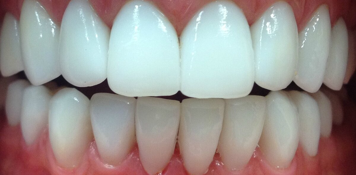 Безметалловая керамика диоксид циркония. Циркониевые передние зубы. Передние зубы коронки цирконий. Коронка на зуб диоксид циркония. Коронки на передние зубы из диоксида циркония.