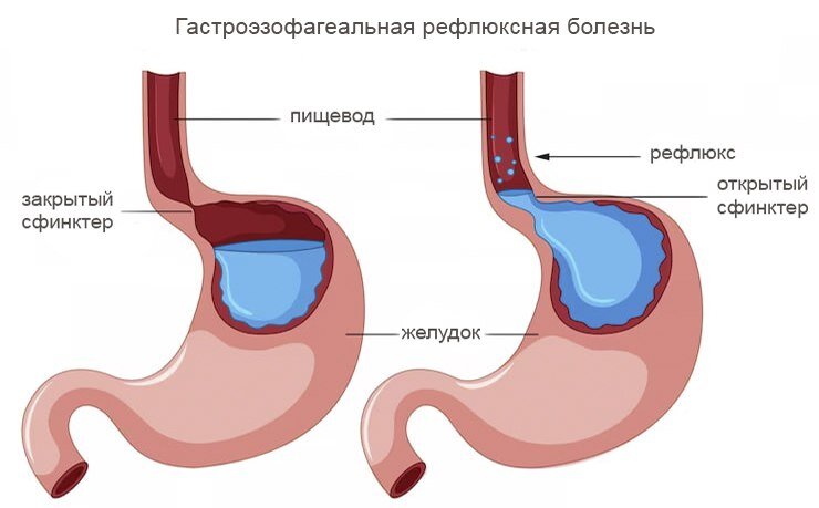Здоровый желудок и желудок при ГЭРБ