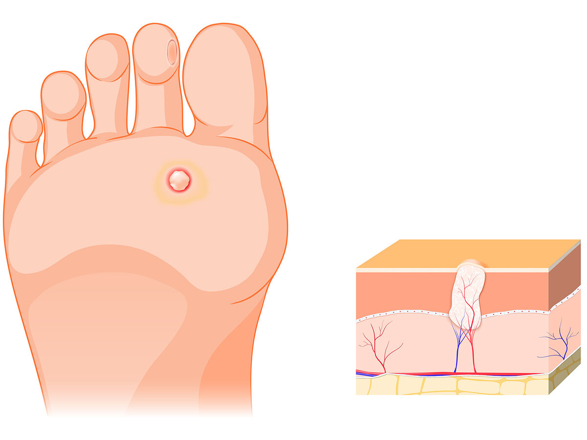 Почему появляются подошвенные бородавки и методы лечения