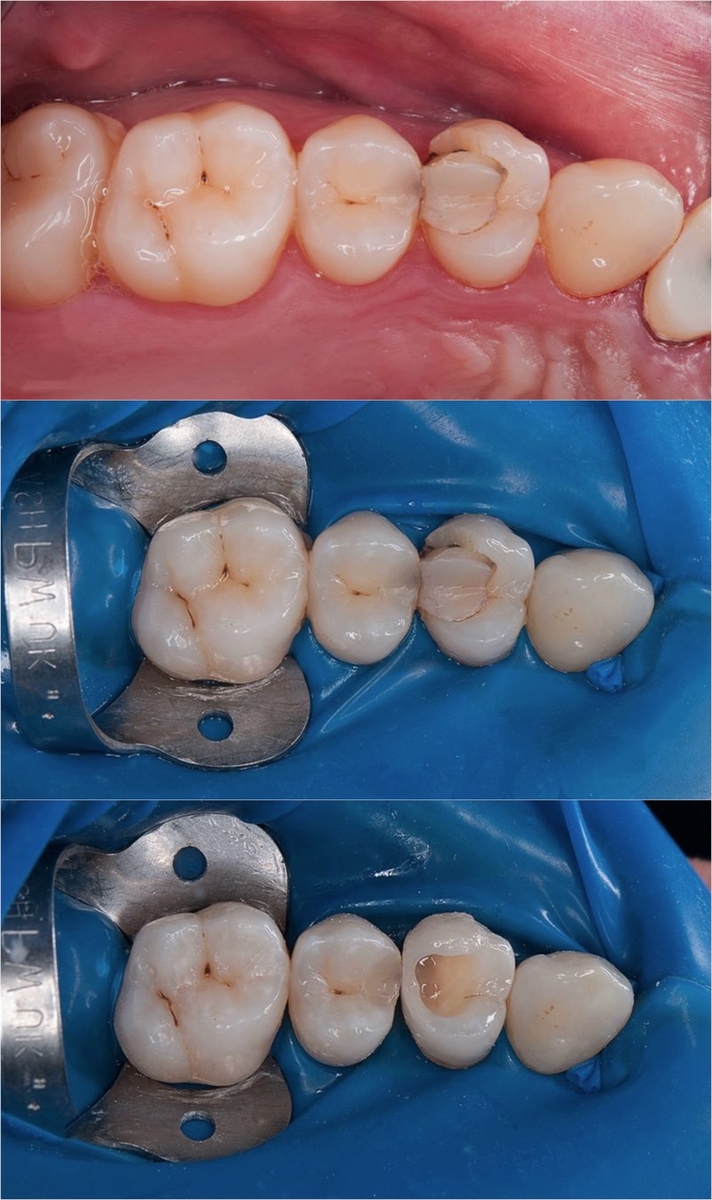 Изоляция зуба при помощи коффердама 
