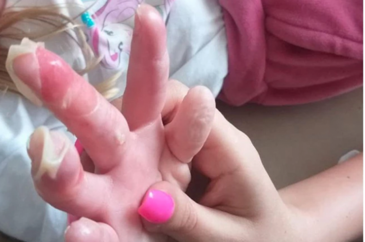    В Новосибирске 8-летняя девочка засунула руку в горячий гипс