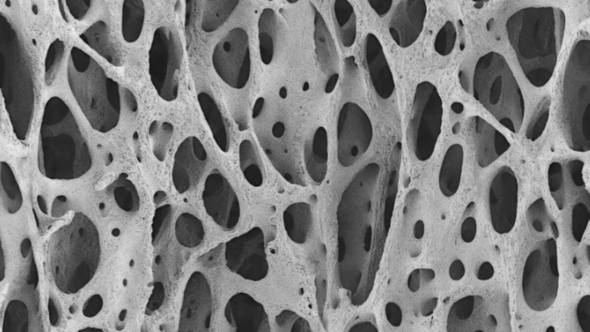 Пористость кости при остеопорозе
