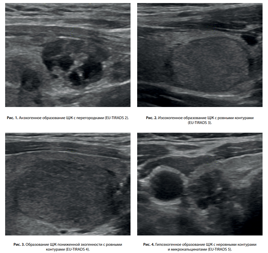 Eu tirads. Классификация Tirads щитовидная железа УЗИ. Тирадс 2 щитовидной железы что это. Классификация тирадс щитовидной железы. Тирадс классификация узлов щитовидной.