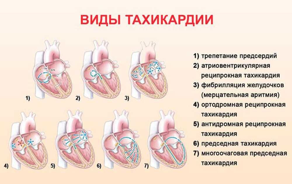 Признаки тахикардии сердца у женщин и мужчин