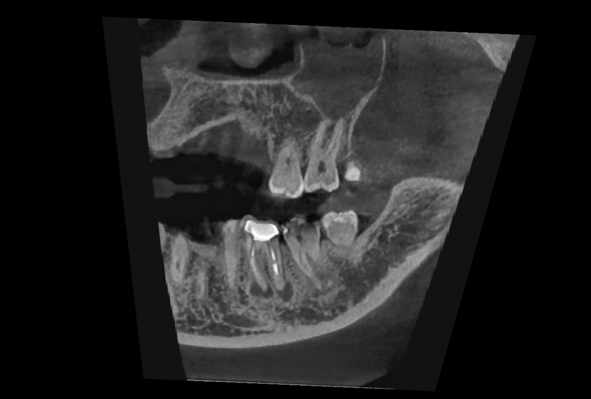 в области верхушек корней