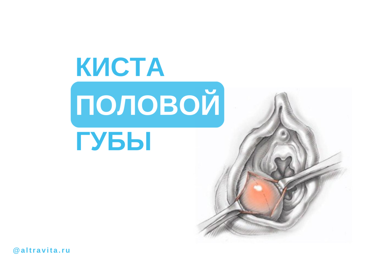 Киста на половой губе фото. Эпидермоидная киста половой губе. Удаление кисты на половой губе.
