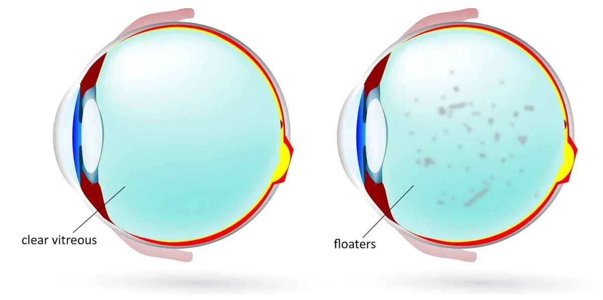    Стекловидное тело и комочки коллагена внутри глазного яблока
