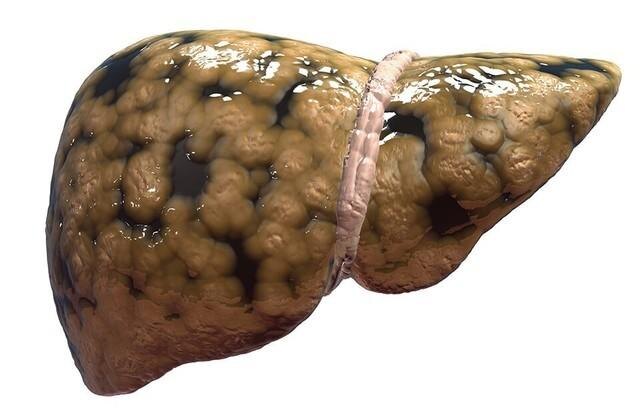 Новая угроза: каждому четвертому грозит ожирение печени!