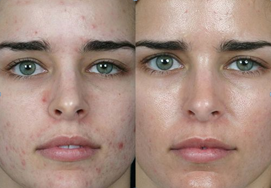Как меняется кожа лица при правильном питании: фото до и после | Magical  Skin | Дзен