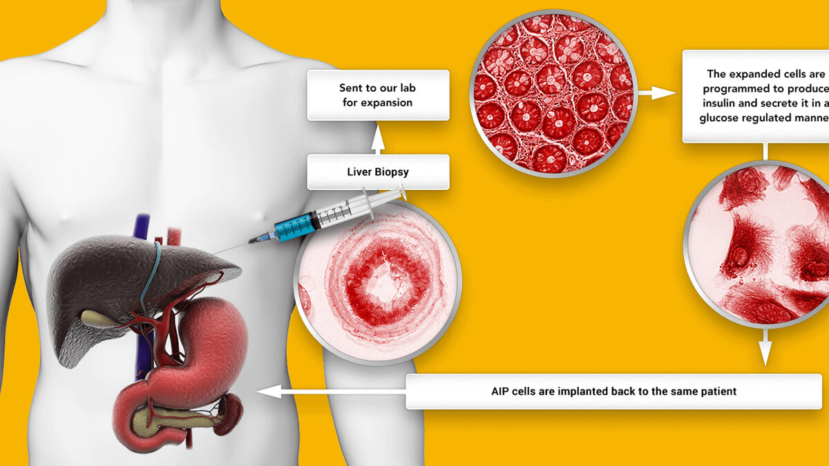 Orgenesis лечение диабета 1 типа клетками печени самого пациента
