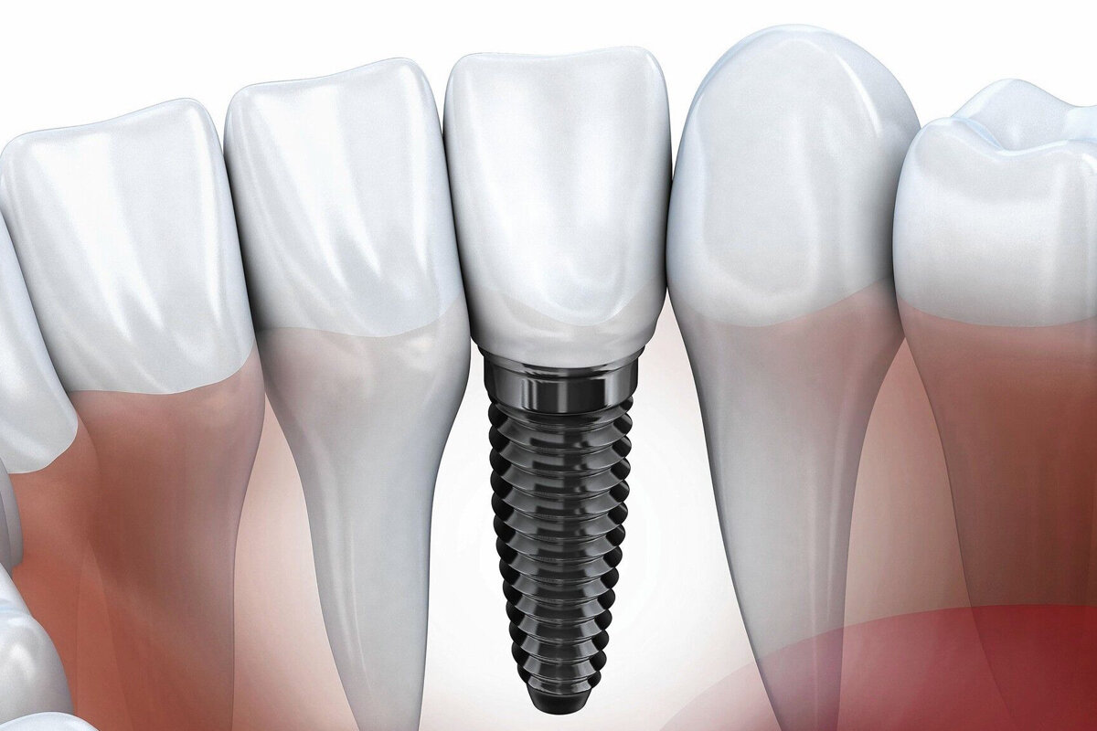 Имплантация – самый естественный вариант восстановления зубов. Потому что замещается не только верхушка, но и корень зуба
