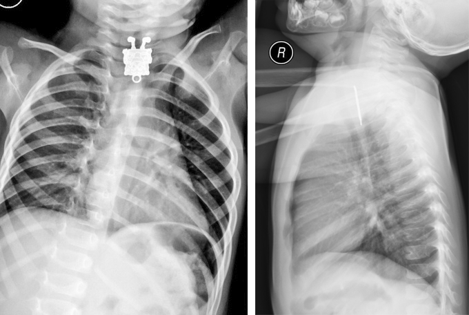 Рентгенограмма помогла найти игрушечного Спанчбоба в пищеводе у полуторагодовалого малыша, но только в «анфас». В боковой проекции ее видно не было