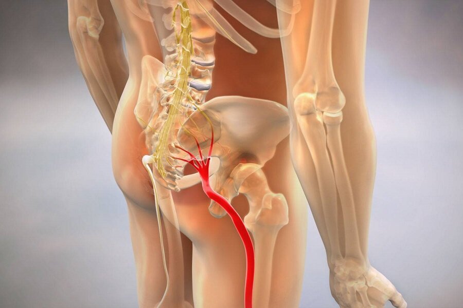 Эффективное лечение ишиас: воспаление седалищного нерва