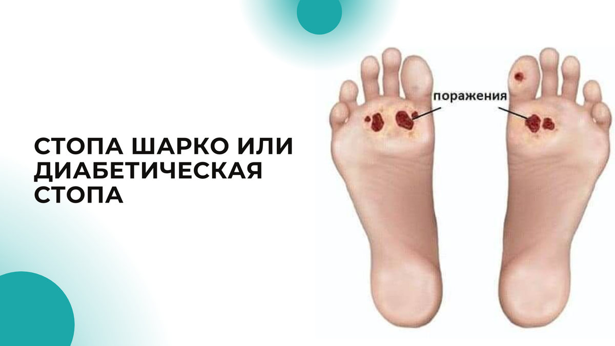 Лечение синдрома диабетической стопы в Калуге по привлекательным ценам