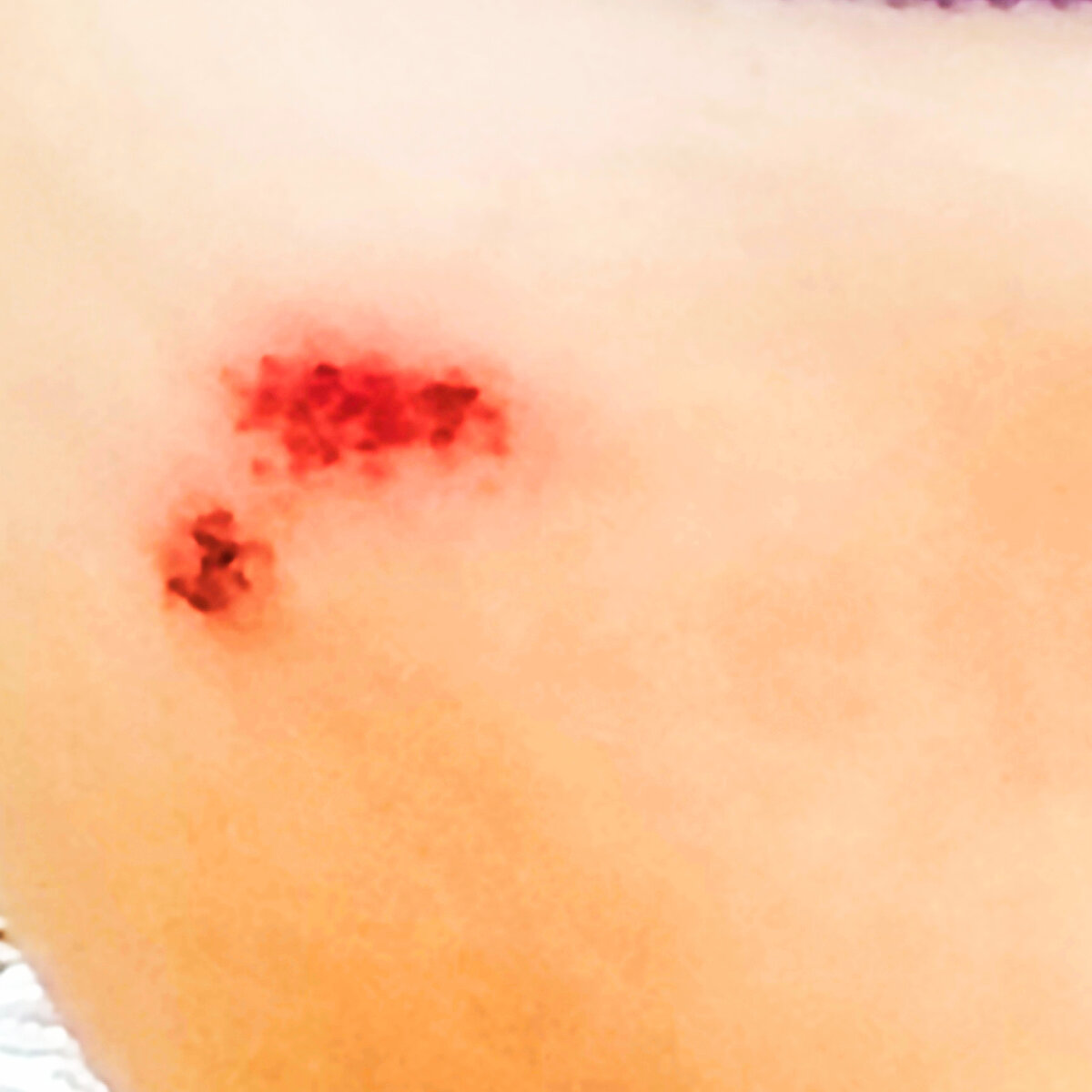 Вот такая болячка. Маленькая и противная