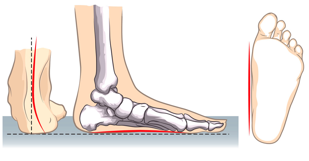 Продольное двухстороннее плоскостопие. Статическое плоскостопие. Продольное плоскостопие. Стопы при плоскостопии.