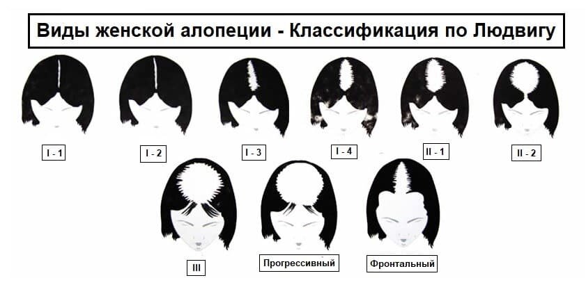 Как скрыть залысины и шрамы на голове: топ-лайфхаки от парикмахера