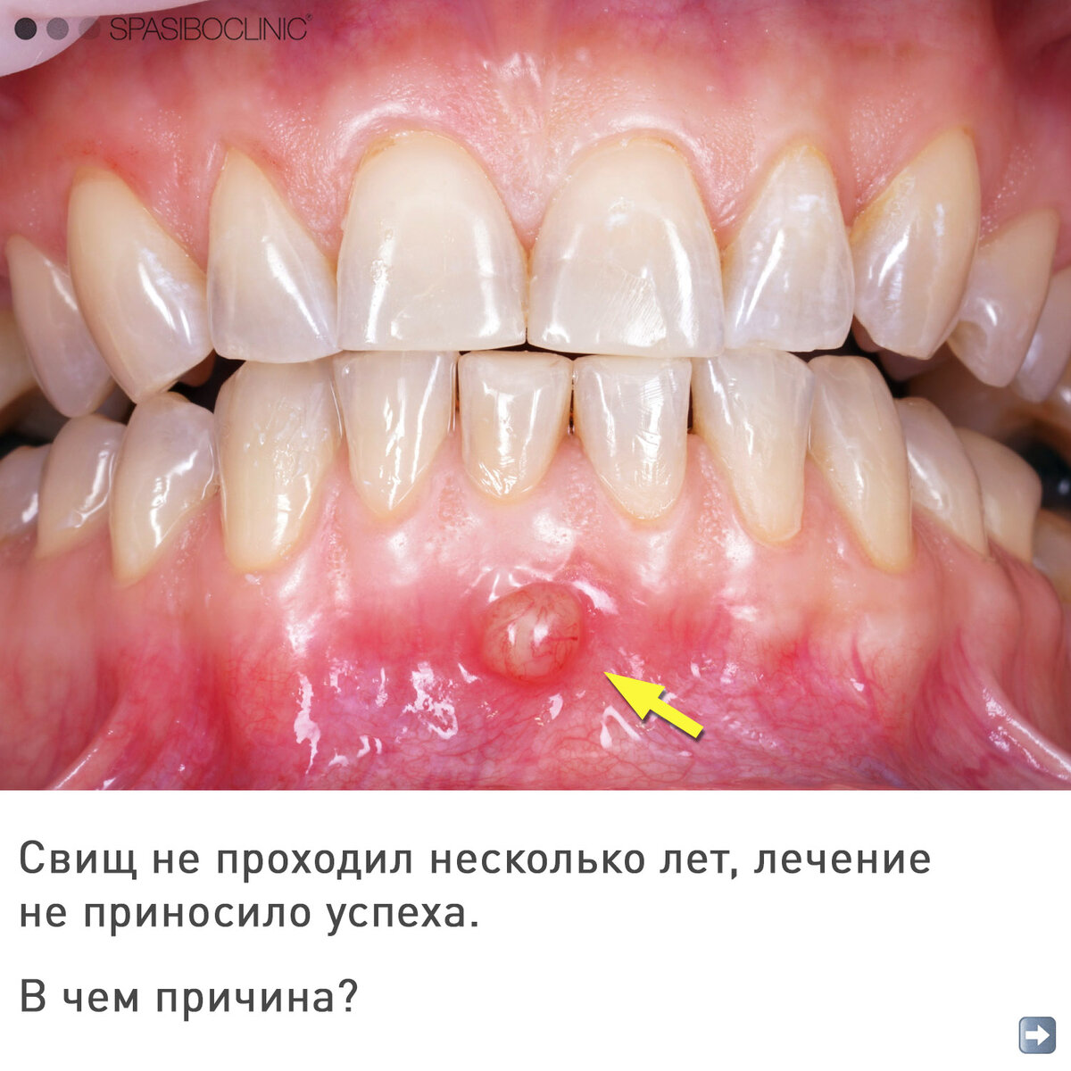 Даже под микроскопом сложно было обнаружить скрытый канал!⬆️  Природа бесконечно разнообразна🤓 

⚙️Терапия — Ксения Резникова @dr_reznikovaksenya НЕОБХОДИМА КОНСУЛЬТАЦИЯ СПЕЦИАЛИСТА🤓  -2