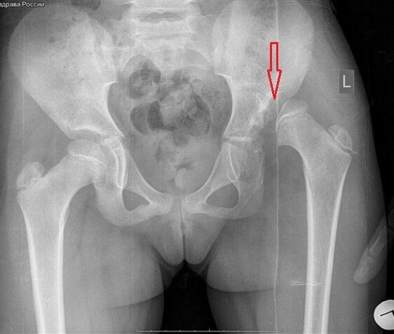 Рентген костей таза в 1-ой проекции