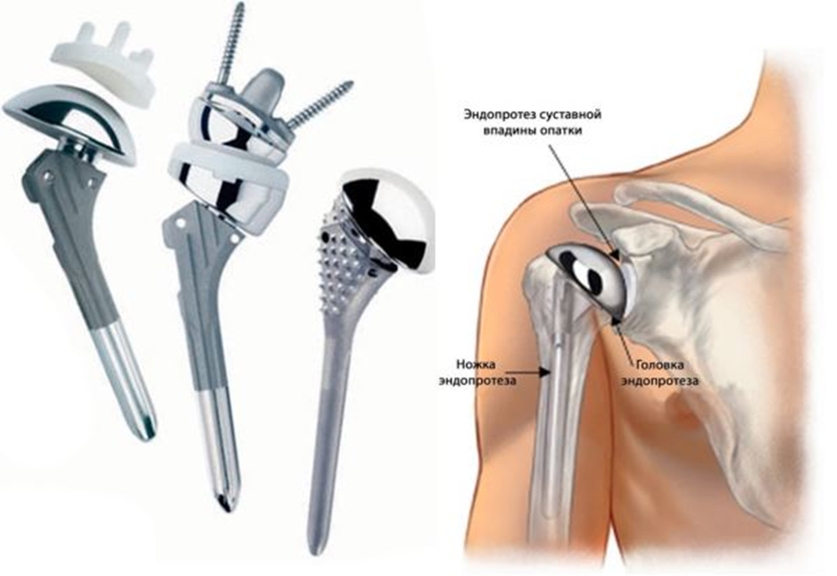 Операция эндопротезирования плечевого сустава. Реверсивный эндопротез плечевого сустава. Эндопротез ревизионный плечевого сустава. Эндопротез плечевого сустава Тотальный реверсивный. Однополюсное эндопротезирование плечевого сустава.