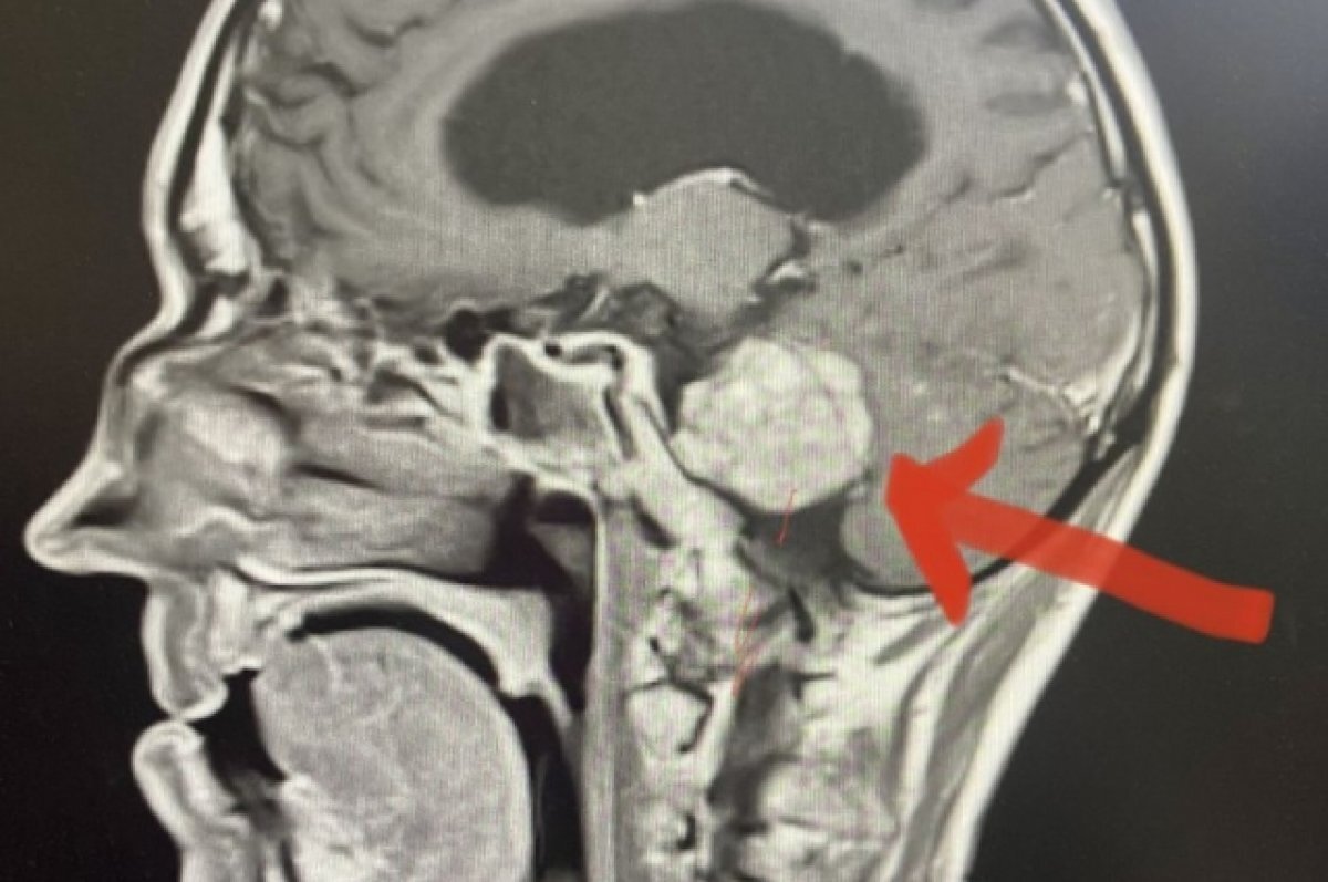    В Омске впервые вылечили пациентов с опухолями ствола головного мозга