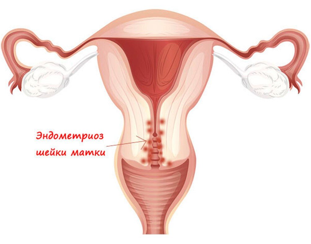 Чем опасен ЭНДОМЕТРИОЗ матки, яичников и брюшины? Причины, симптомы и ...