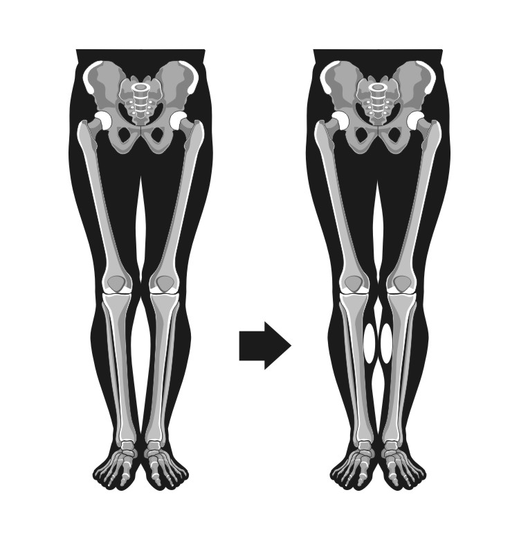 Кривые колени | Как исправить кривые колени в СМ-Пластика