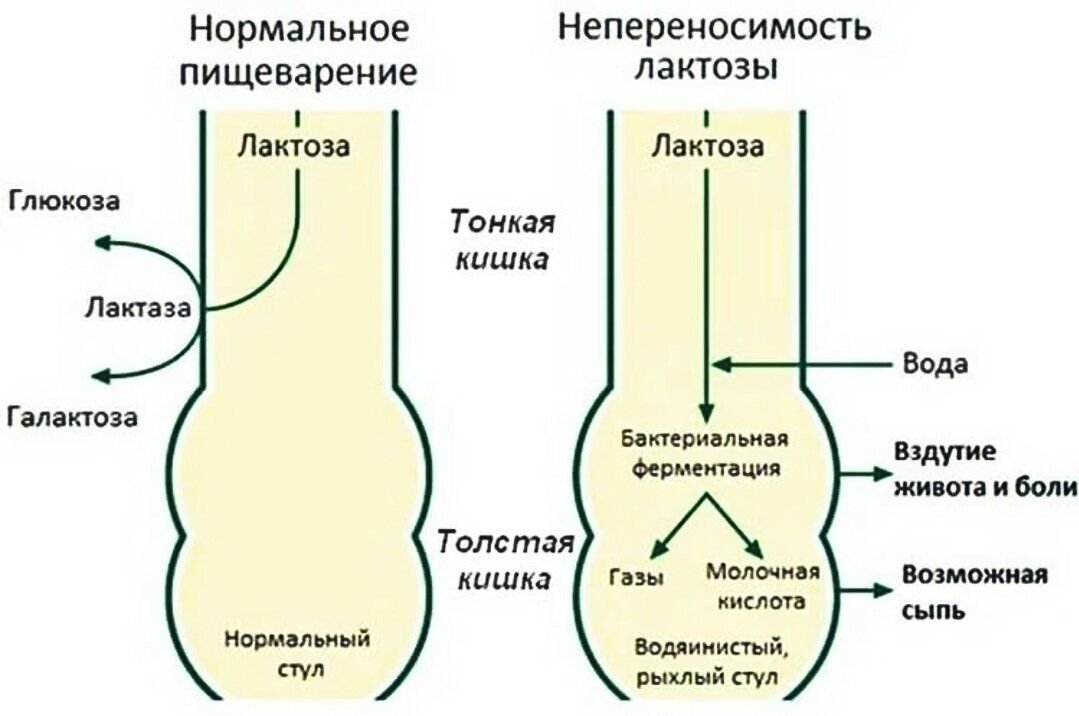 Дефицит лактазы