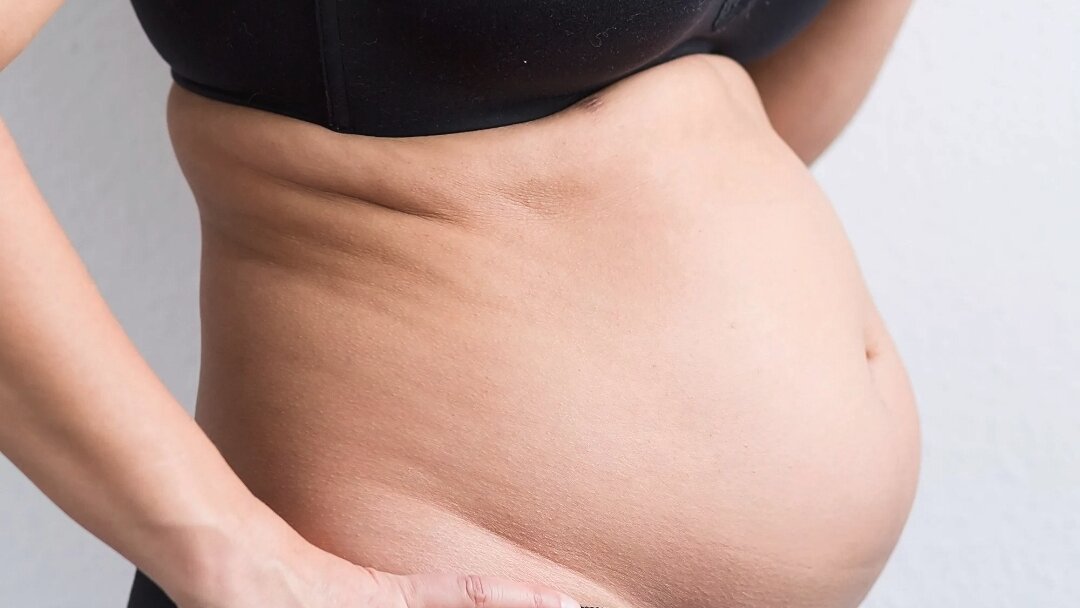 Он бывает даже у довольно стройных 